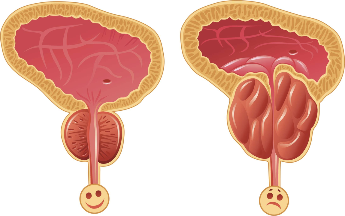 Prostatitin varlığı nasıl belirlenir
