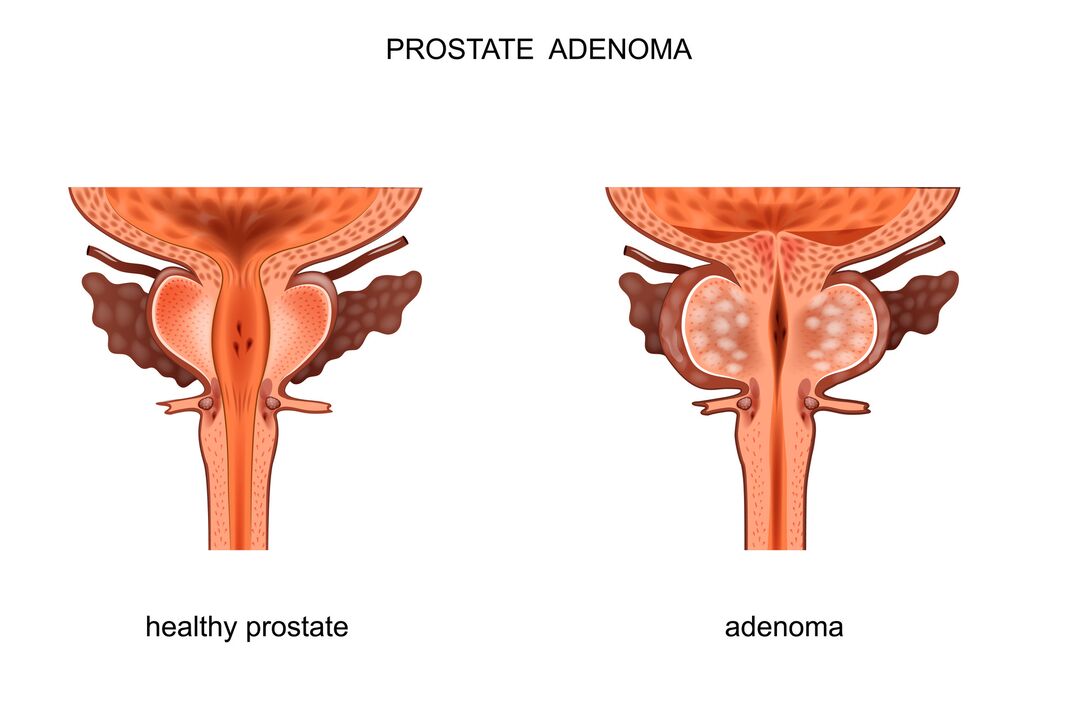 Sağlıklı prostat ve adenom