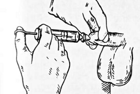 prostatit için aşılar