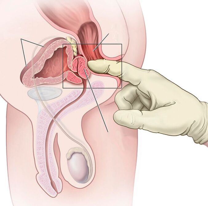 Prostatit tedavisi için prostat masajı