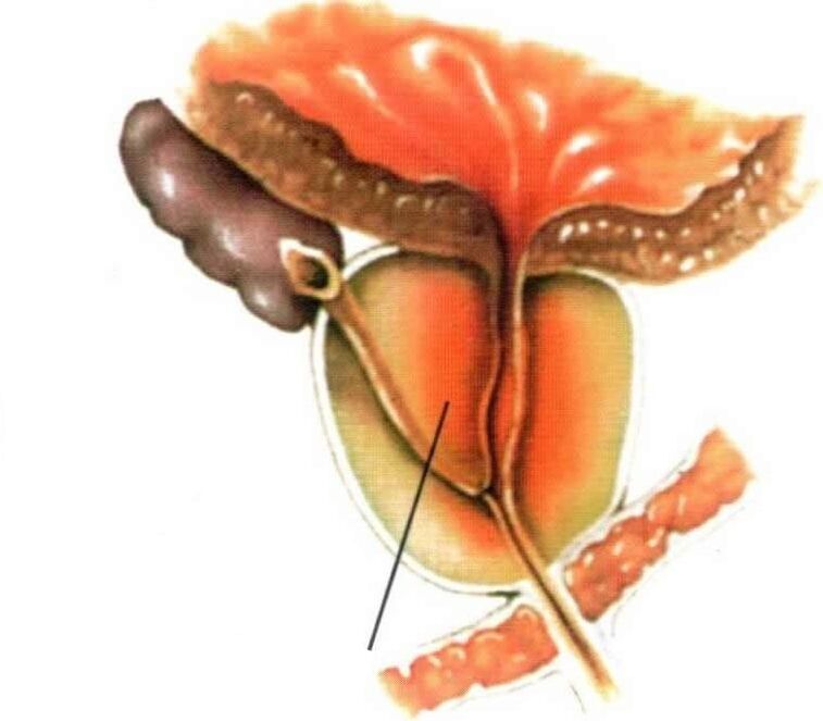 Kronik prostatitte prostat dokusunun iltihabı